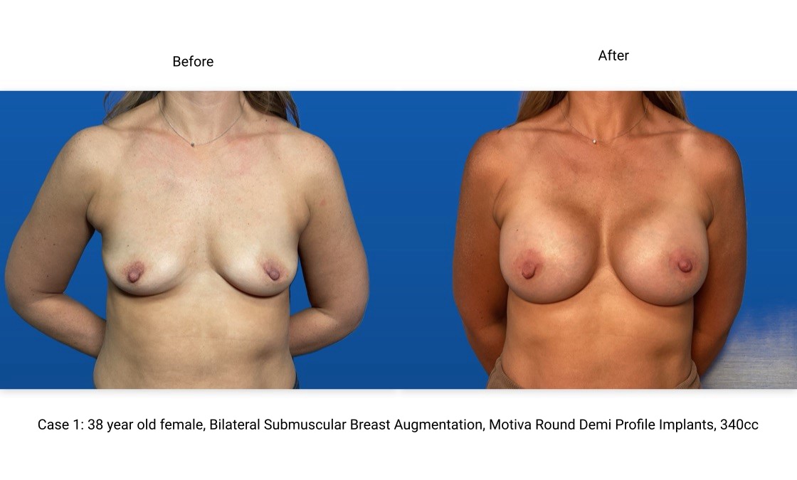 Case 1 Breast Augmentation Front View