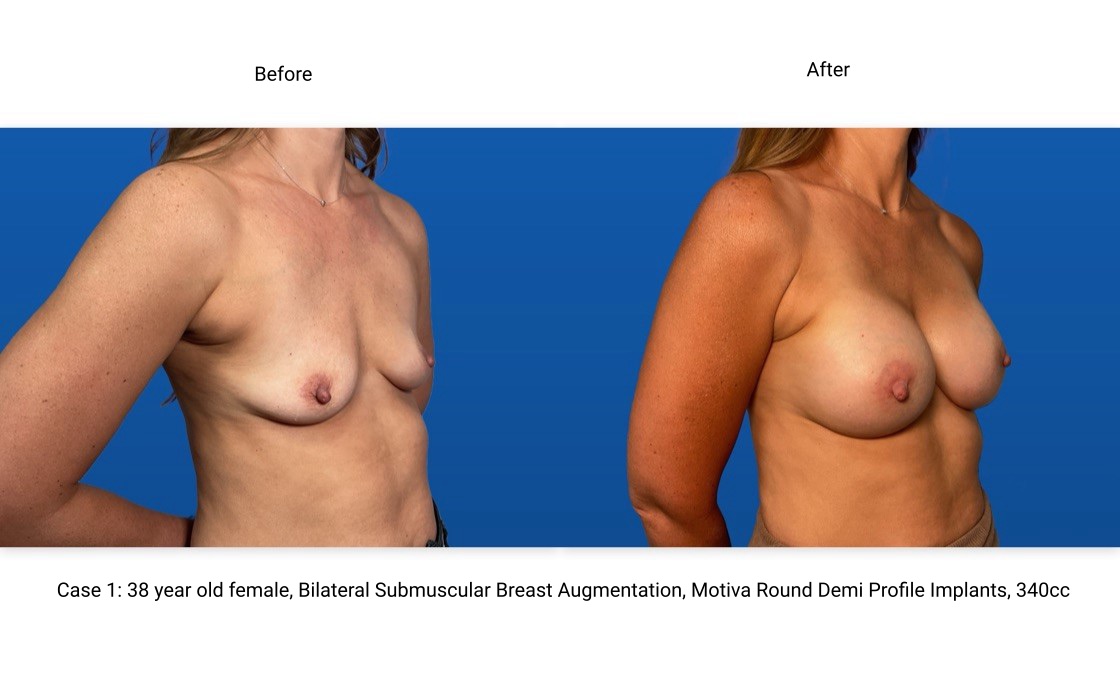 Case 1 Breast Augmentation 3/4 View