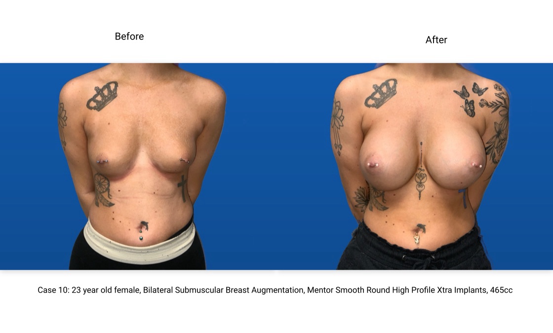 Case 10 Breast Augmentation Front View