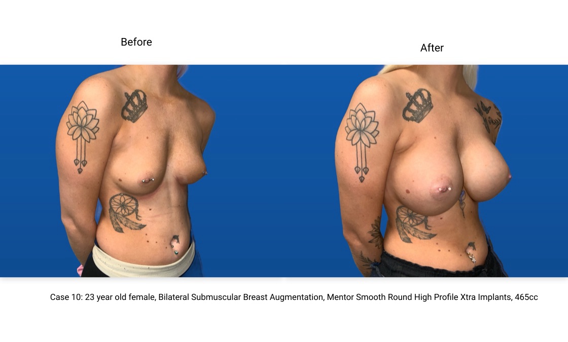 Case 10 Breast Augmentation 3/4 View