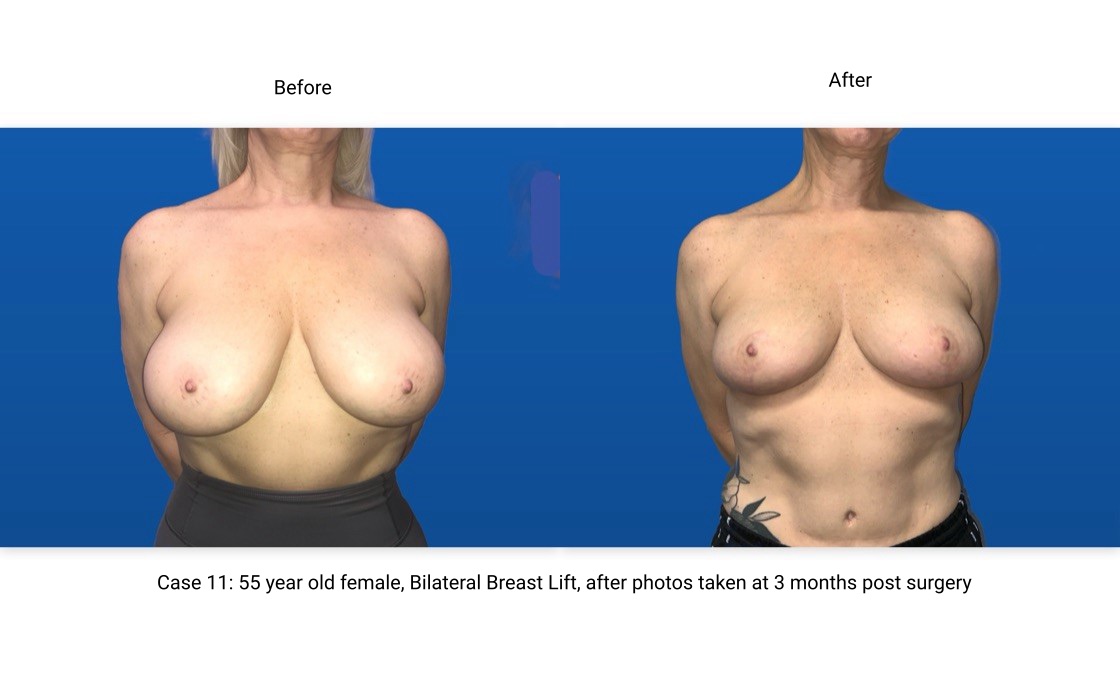 Case 11 Breast Lift Front View