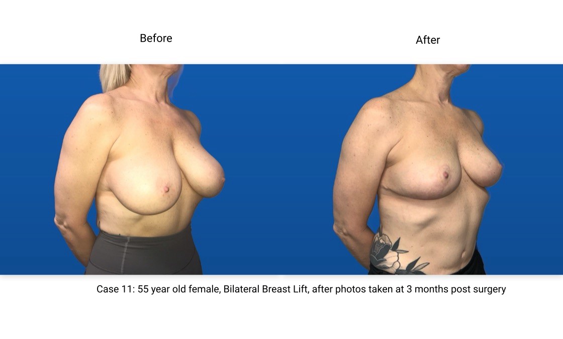 Case 11 Breast Lift 3/4 View