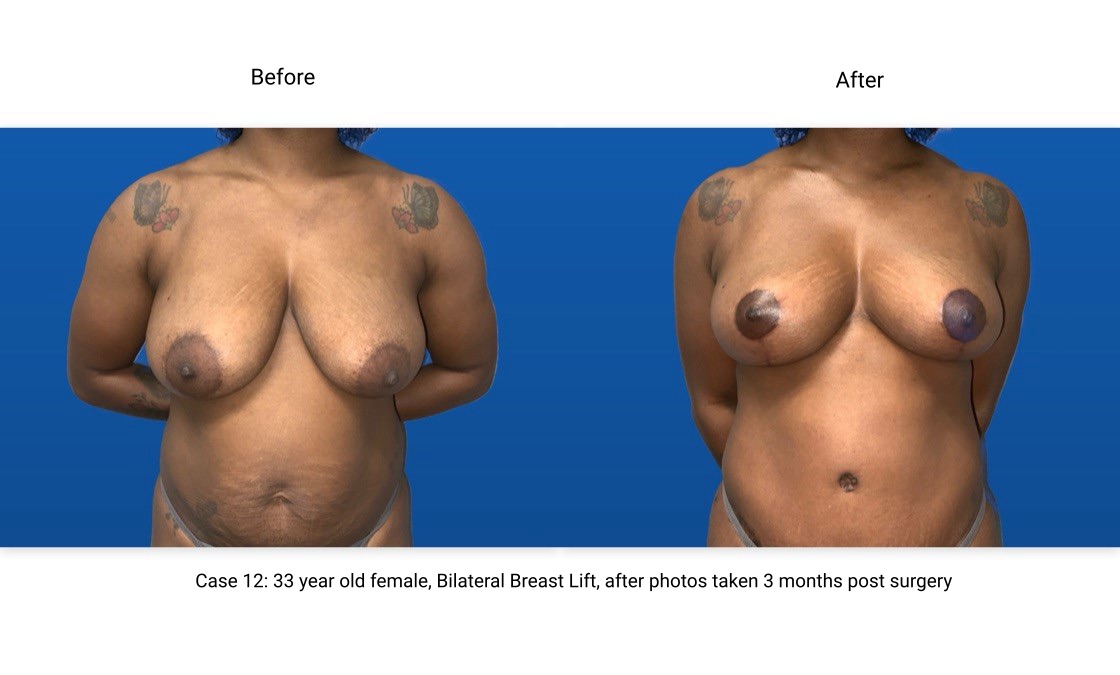 Case 12 Breast Lift Front View