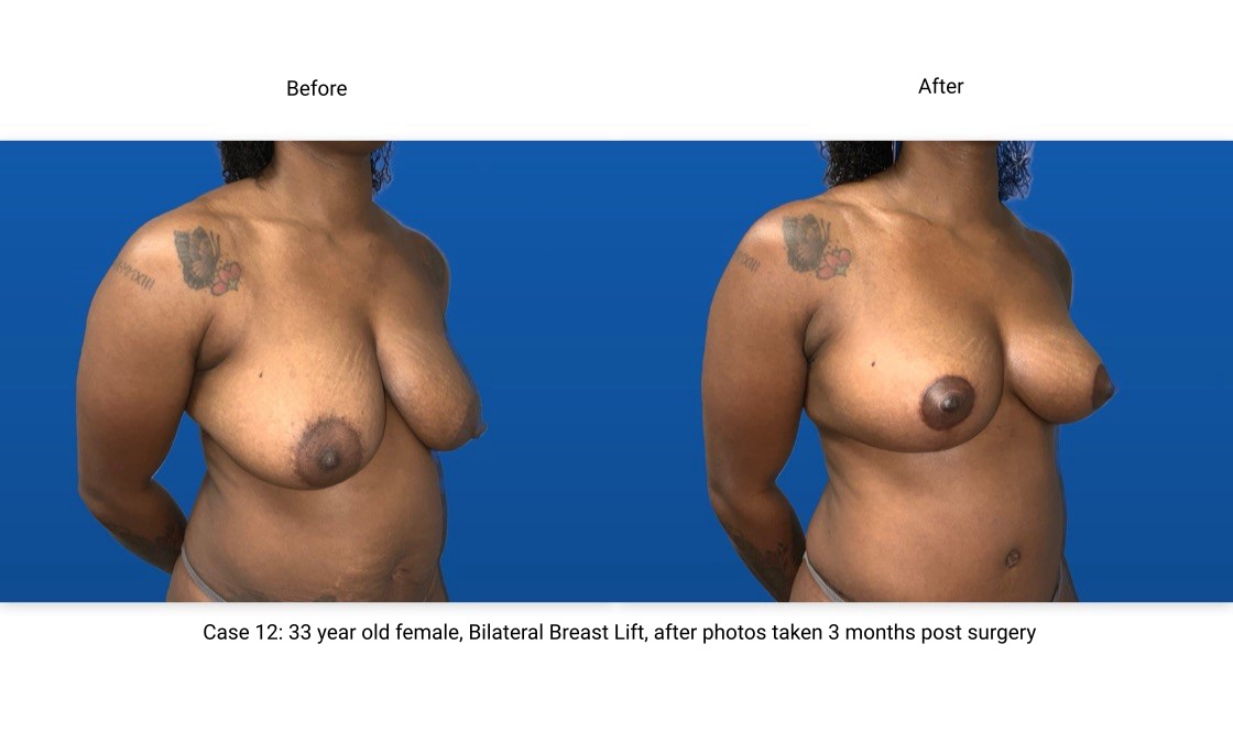 Case 12 Breast Lift 3/4 View
