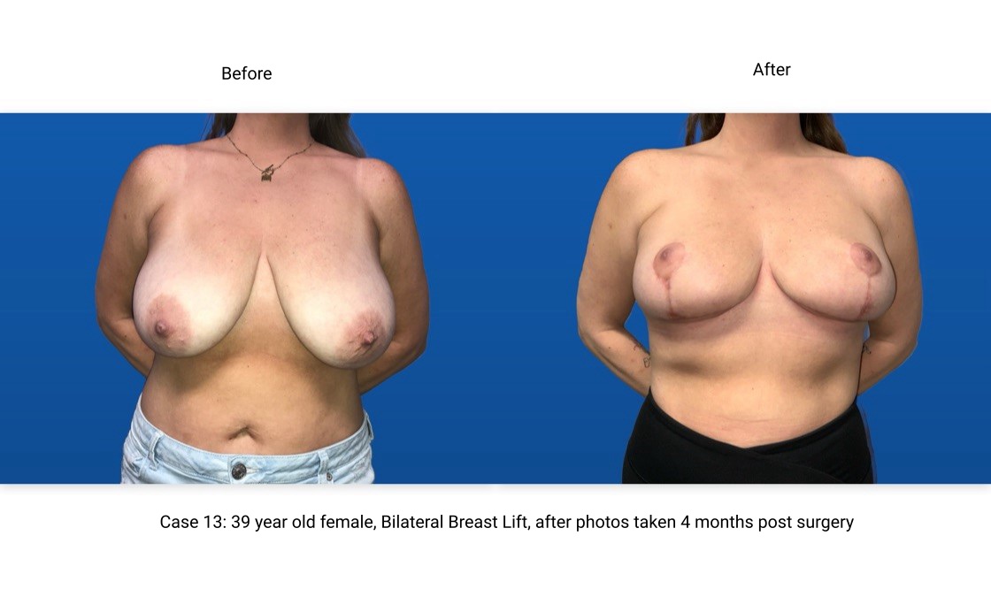 Case 13 Breast Lift Front View