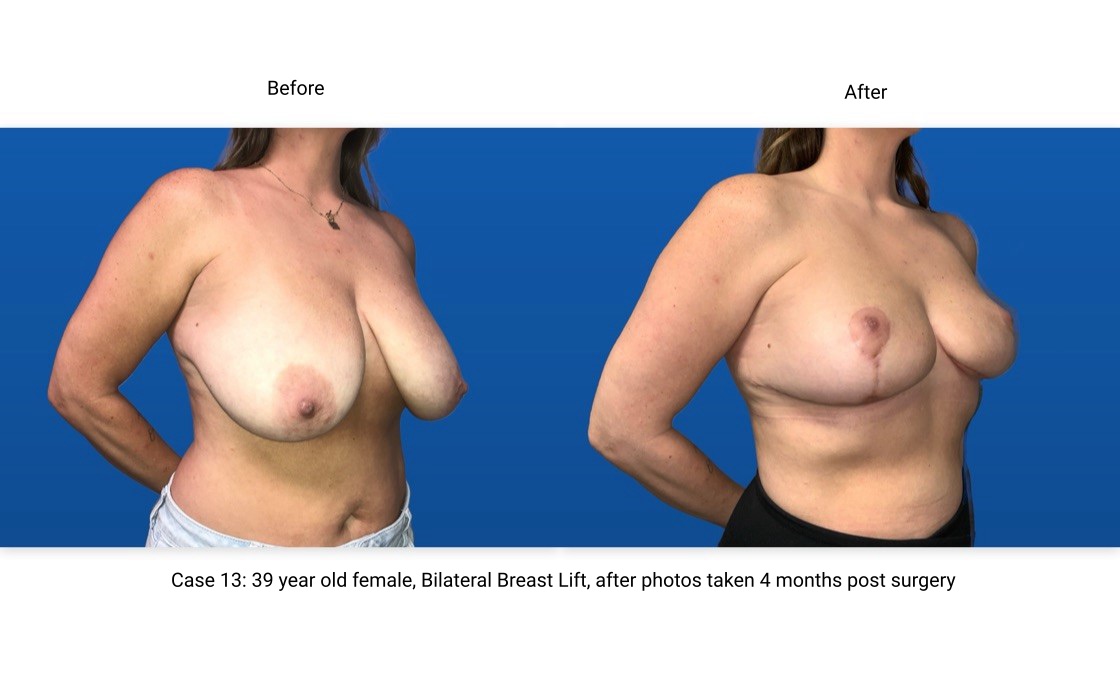 Case 13 Breast Lift 3/4 View