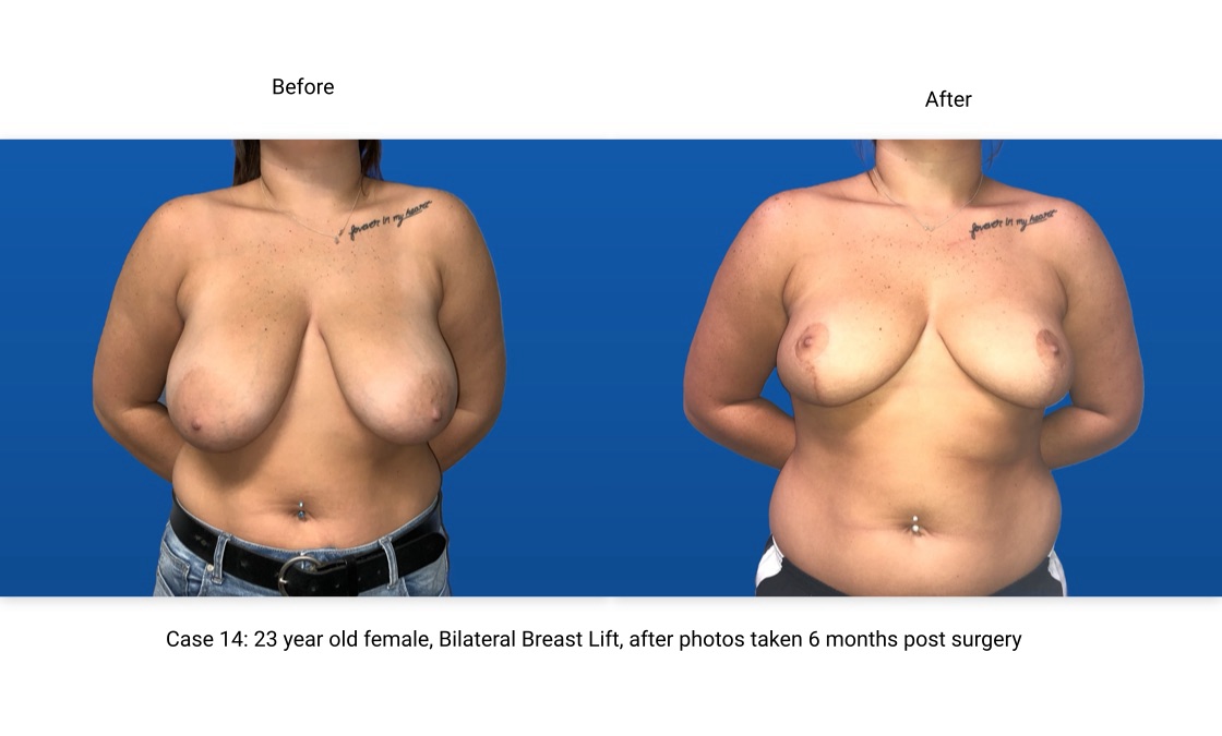 Case 14 Breast Lift Front View