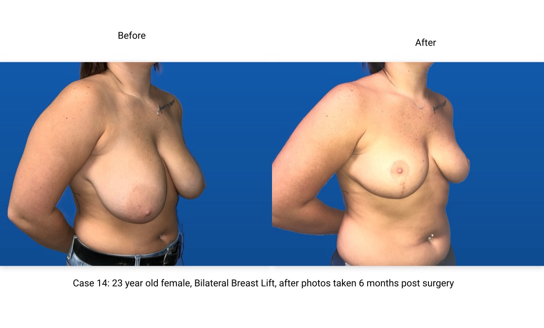 Case 14 Breast Lift 3/4 View