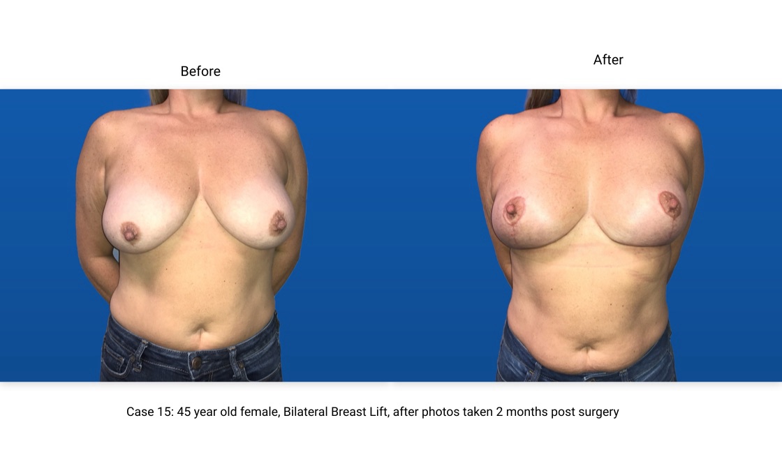 Case 15 Breast Lift Front View