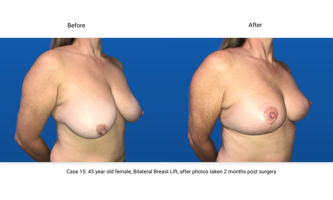Case 15 Breast Lift 3/4 View
