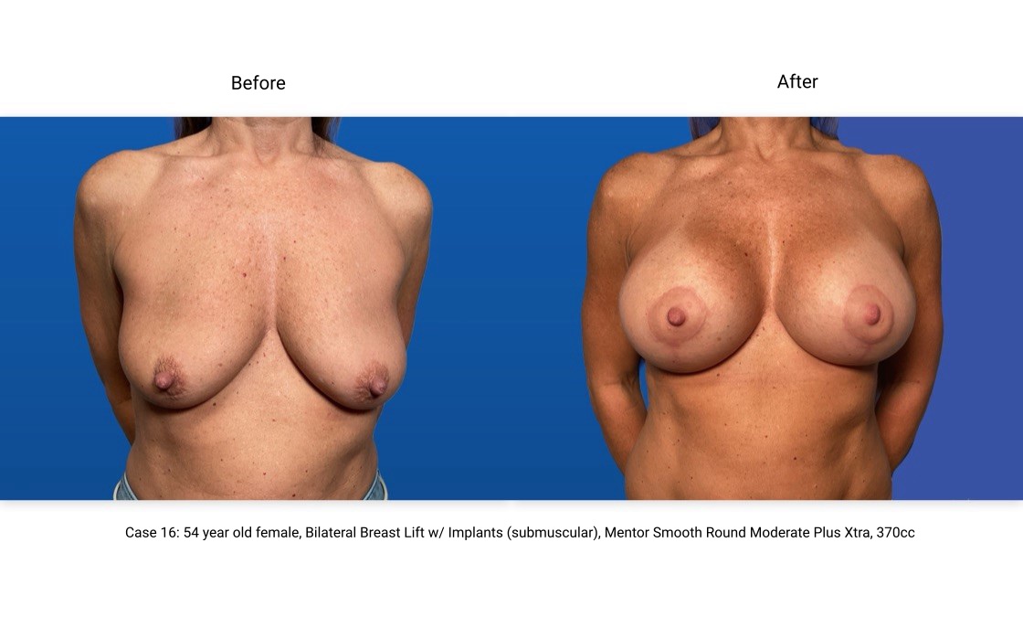 Case 16 Breast Lift with Implants Front View
