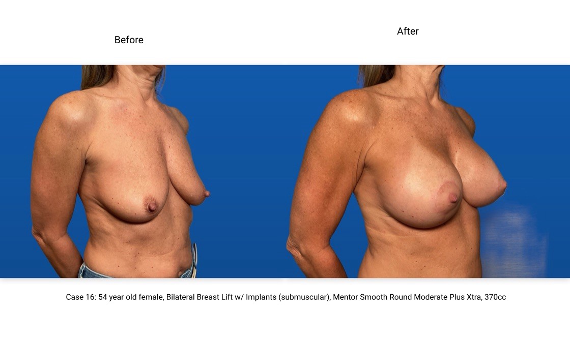 Case 16 Breast Lift with Implants 3/4 View