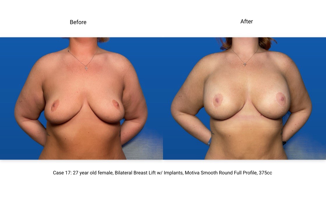 Case 17 Breast Lift with Implants Front View