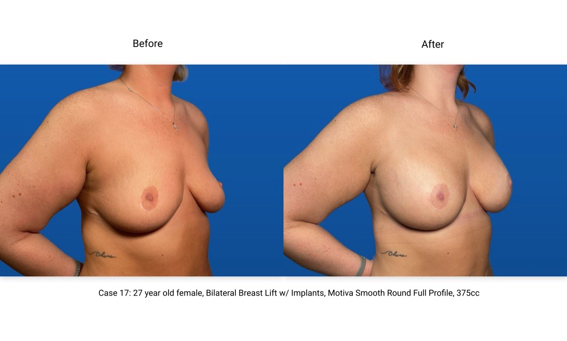 Case 17 Breast Lift with Implants 3/4 View