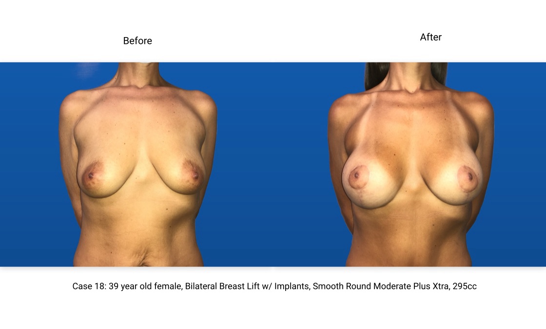 Case 18 Breast Lift with Implants Front View