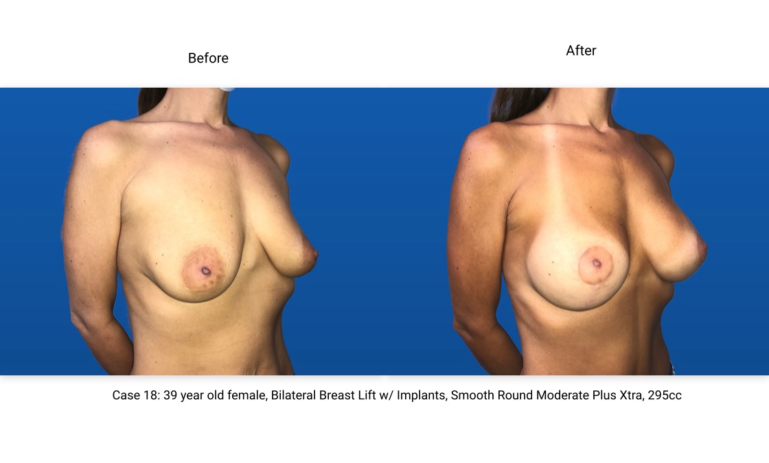 Case 18 Breast Lift with Implants 3/4 View
