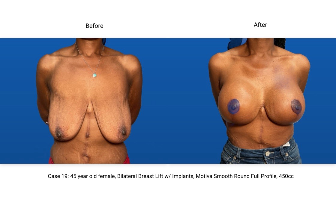 Case 19 Breast Lift with Implants Front View