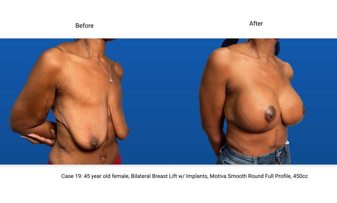 Case 19 Breast Lift with Implants 3/4 View