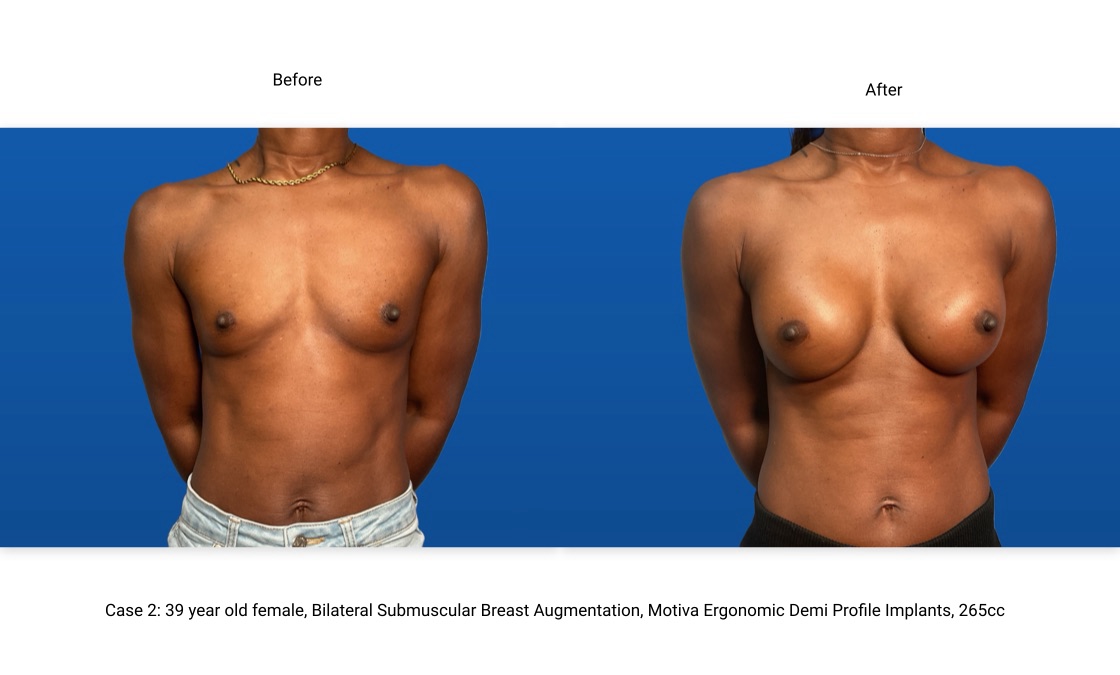 Case 2 Breast Augmentation Front View