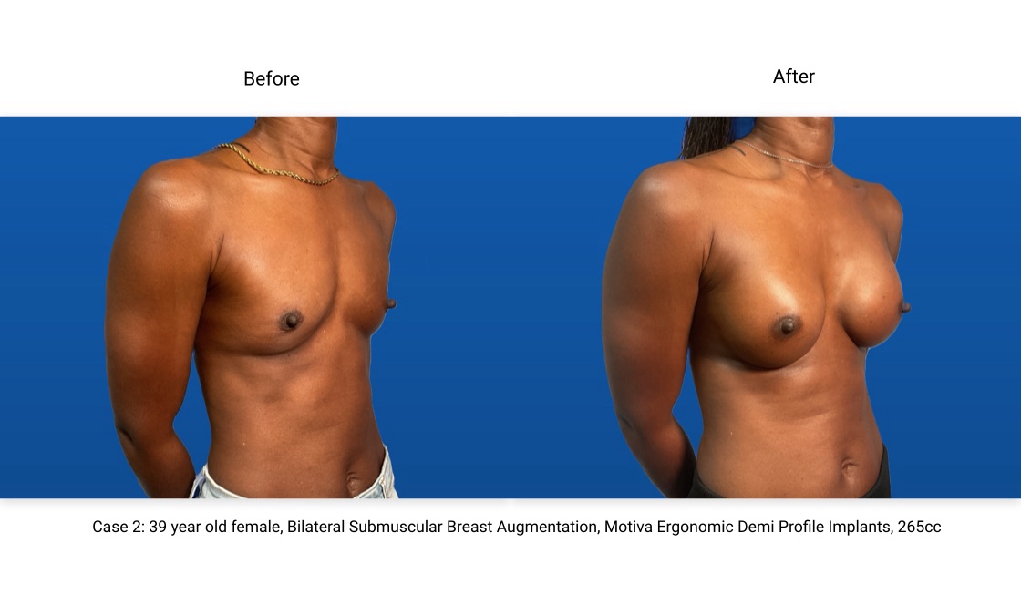 Case 2 Breast Augmentation 3/4 View