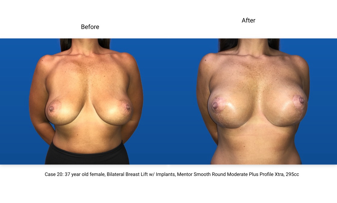 Case 20 Breast Lift with Implants Front View