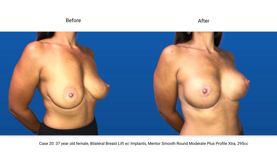 Case 20 Breast Lift with Implants 3/4 View