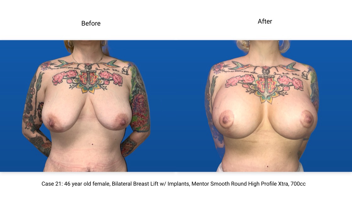 Case 21 Breast Lift with Implants Front View
