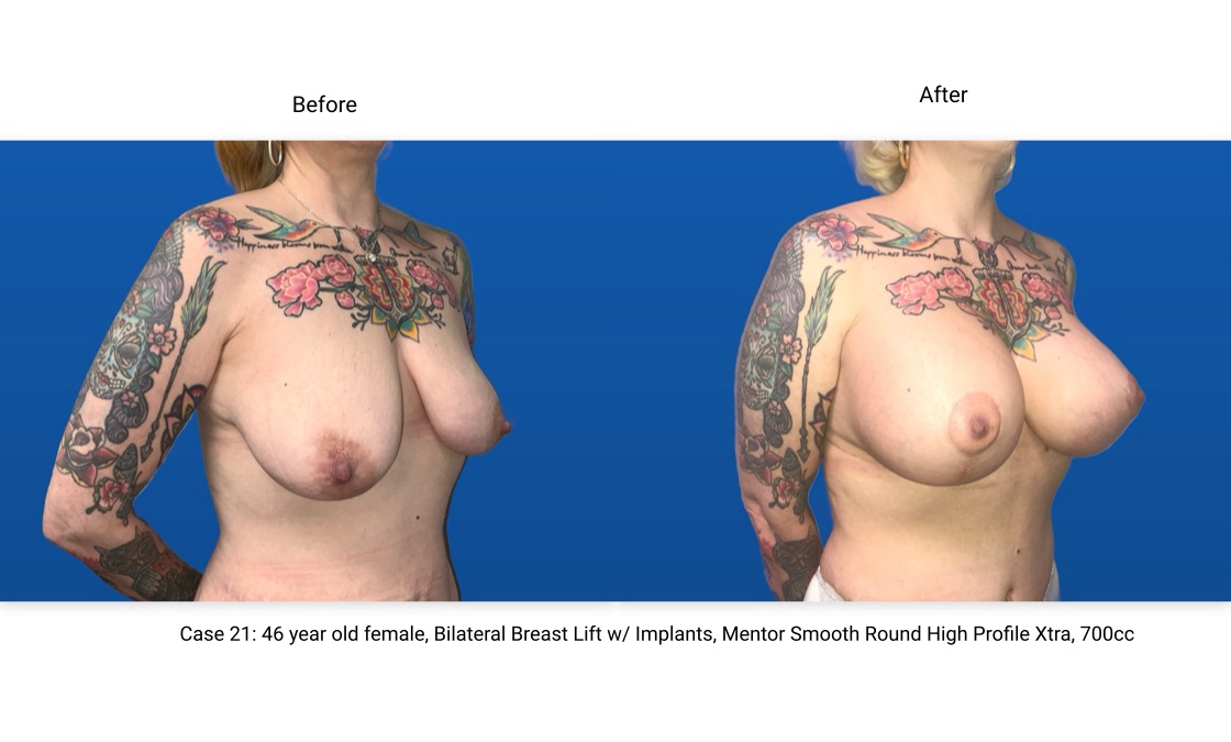 Case 21 Breast Lift with Implants 3/4 View