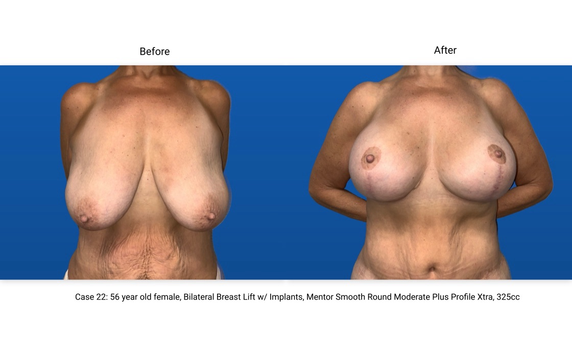 Case 22 Breast Lift with Implants Front View