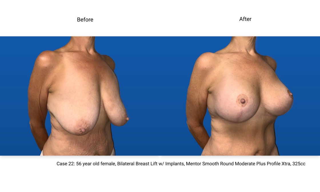 Case 22 Breast Lift with Implants 3/4 View