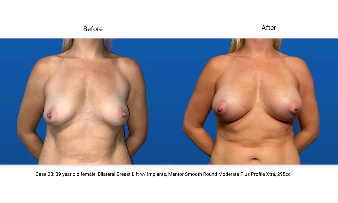 Case 23 Breast Lift with Implants Front View