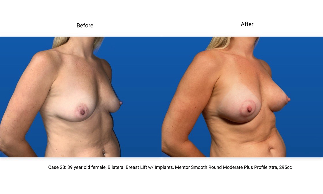 Case 23 Breast Lift with Implants 3/4 View