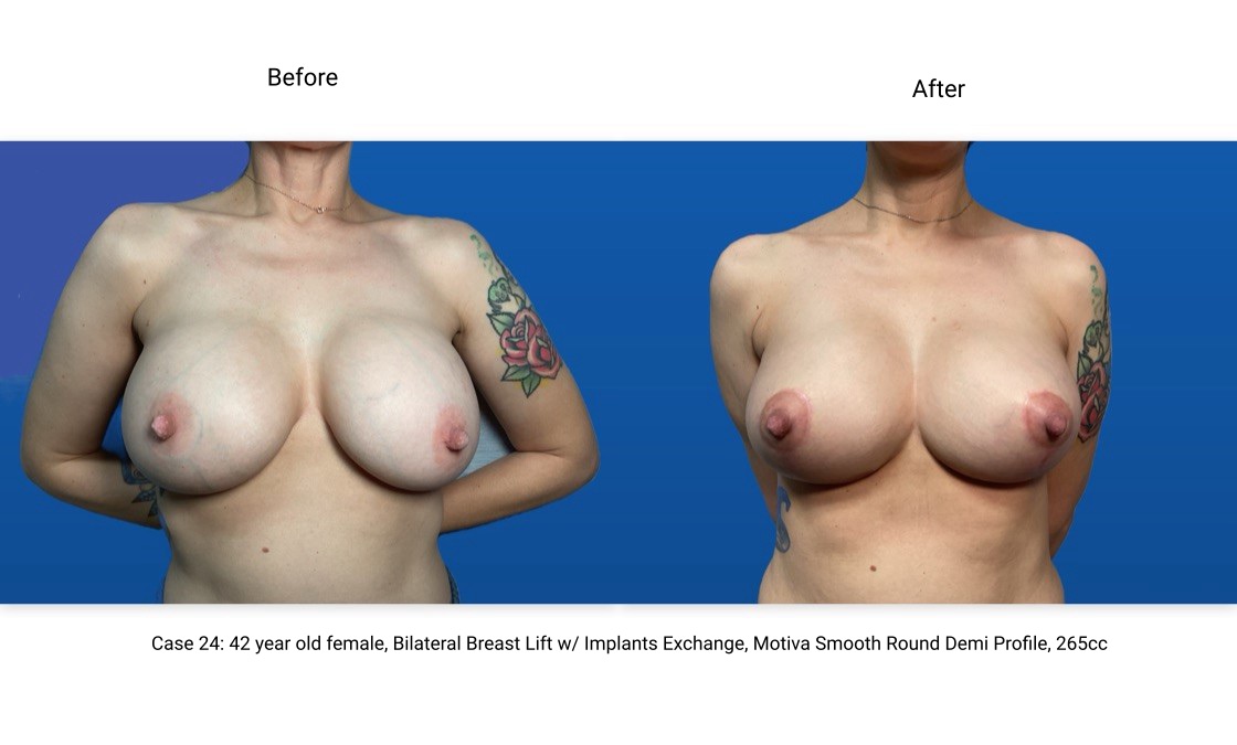 Case 24 Breast Lift with Implants Front View