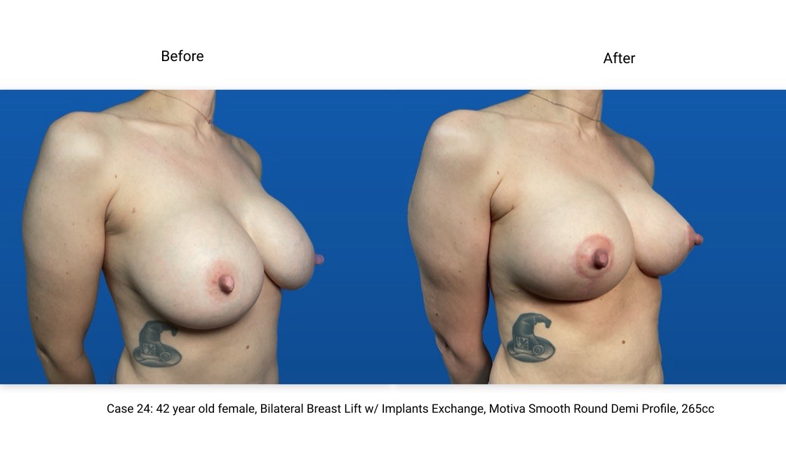 Case 24 Breast Lift with Implants 3/4 View