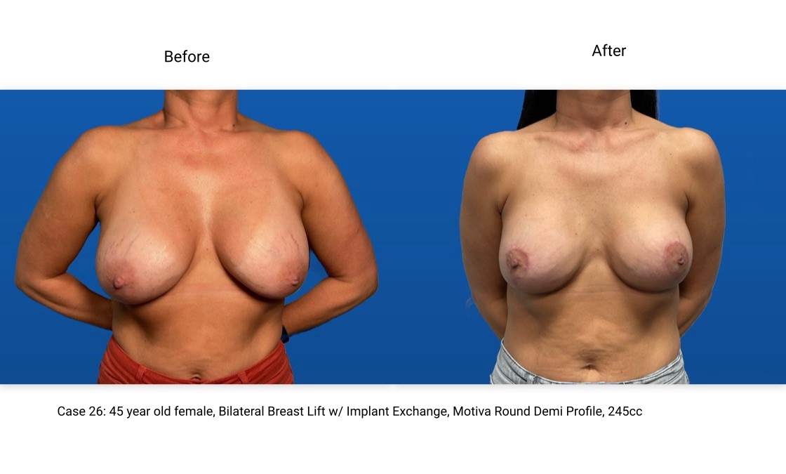 Case 26 Breast Lift with Implants Front View