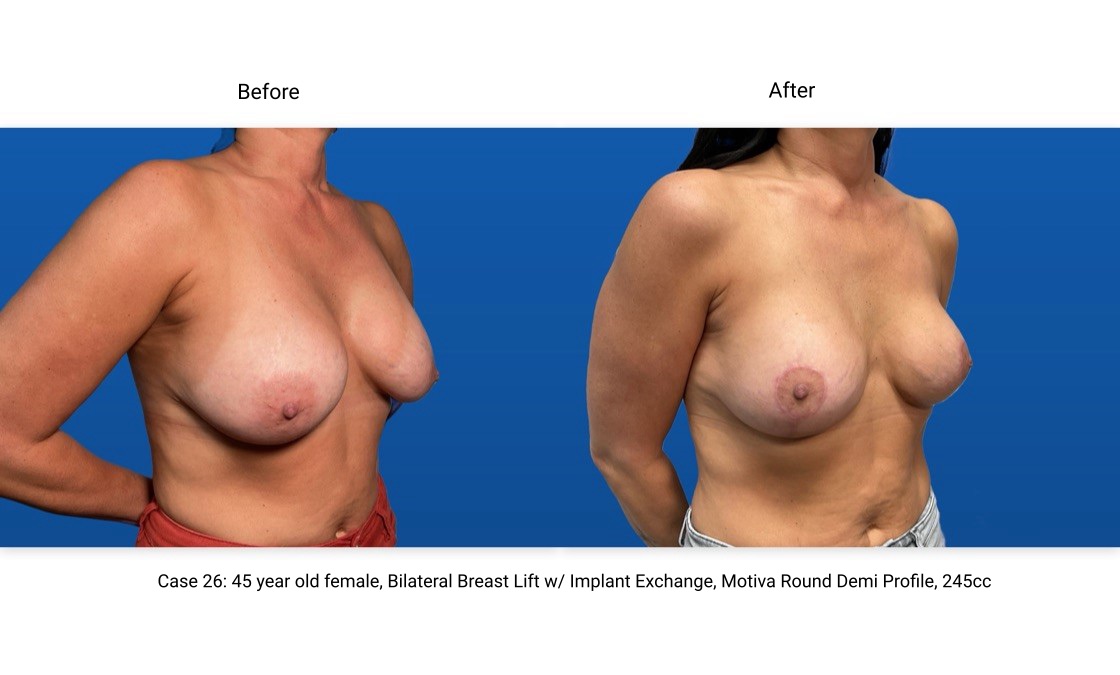 Case 26 Breast Lift with Implants 3/4 View