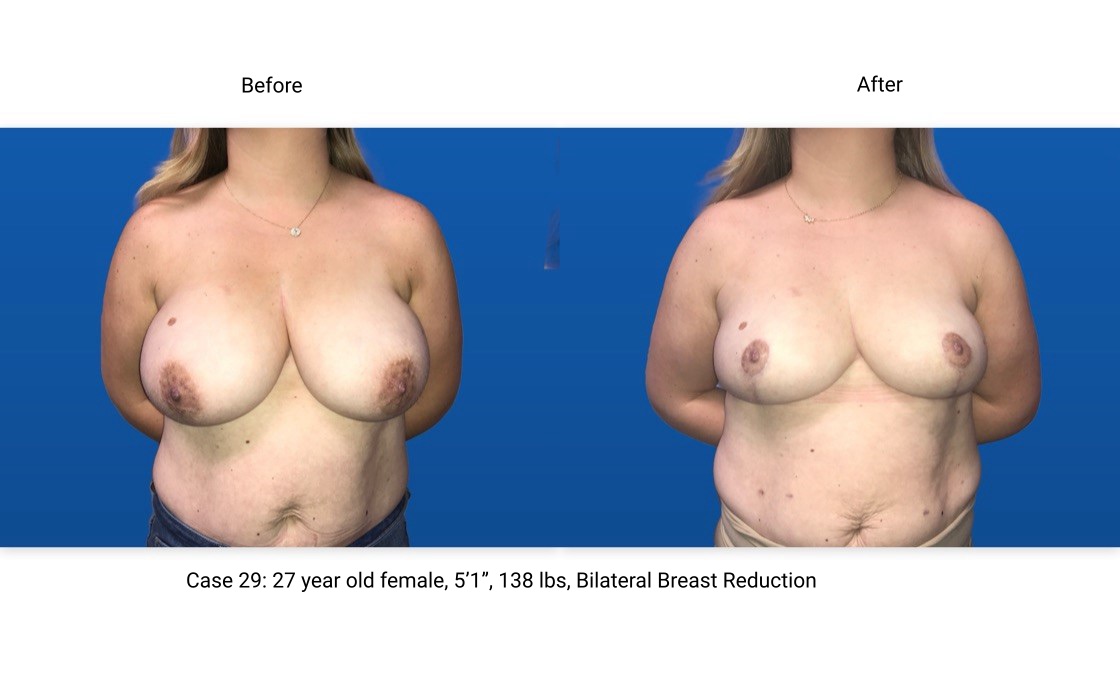 Case 29 Breast Reduction Front View