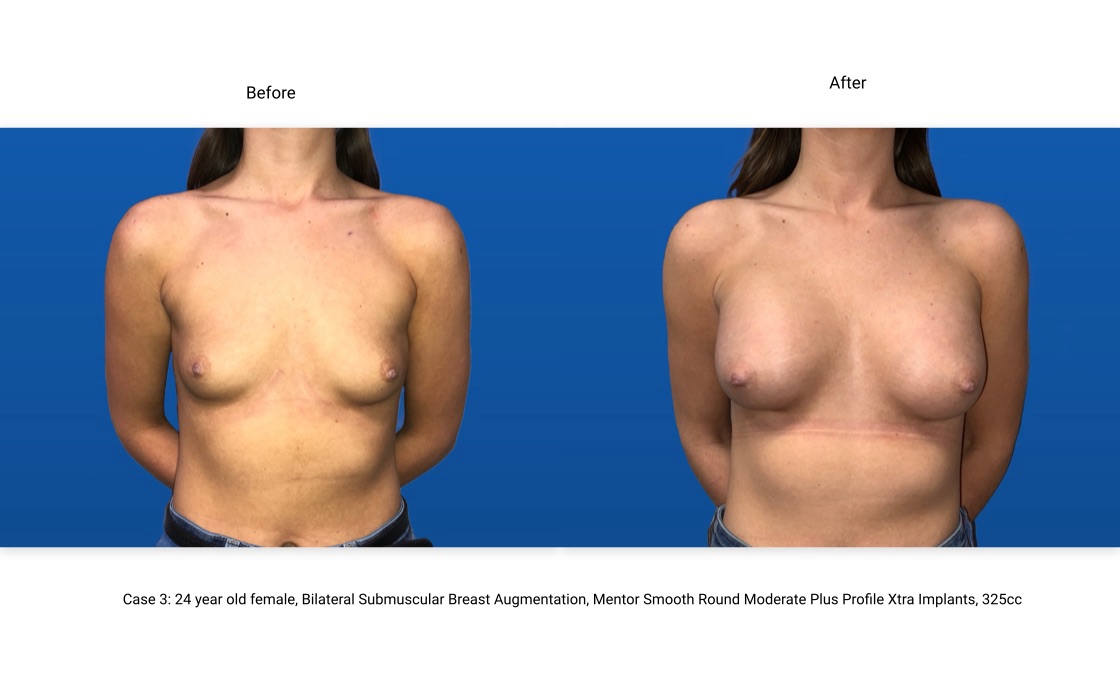 Case 3 Breast Augmentation Front View