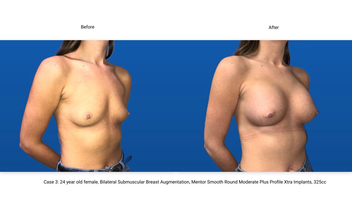 Case 3 Breast Augmentation 3/4 View