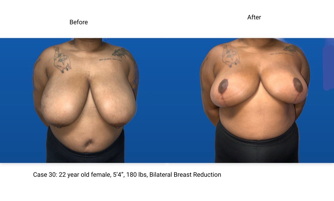Case 30 Breast Reduction Front View