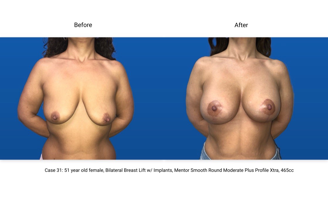 Case 31 Breast Lift with Implants Front View
