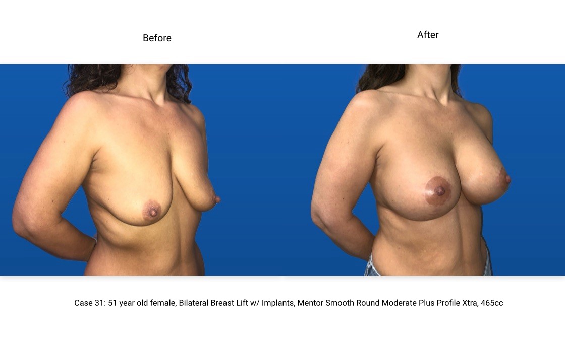 Case 31 Breast Lift with Implants 3/4 View