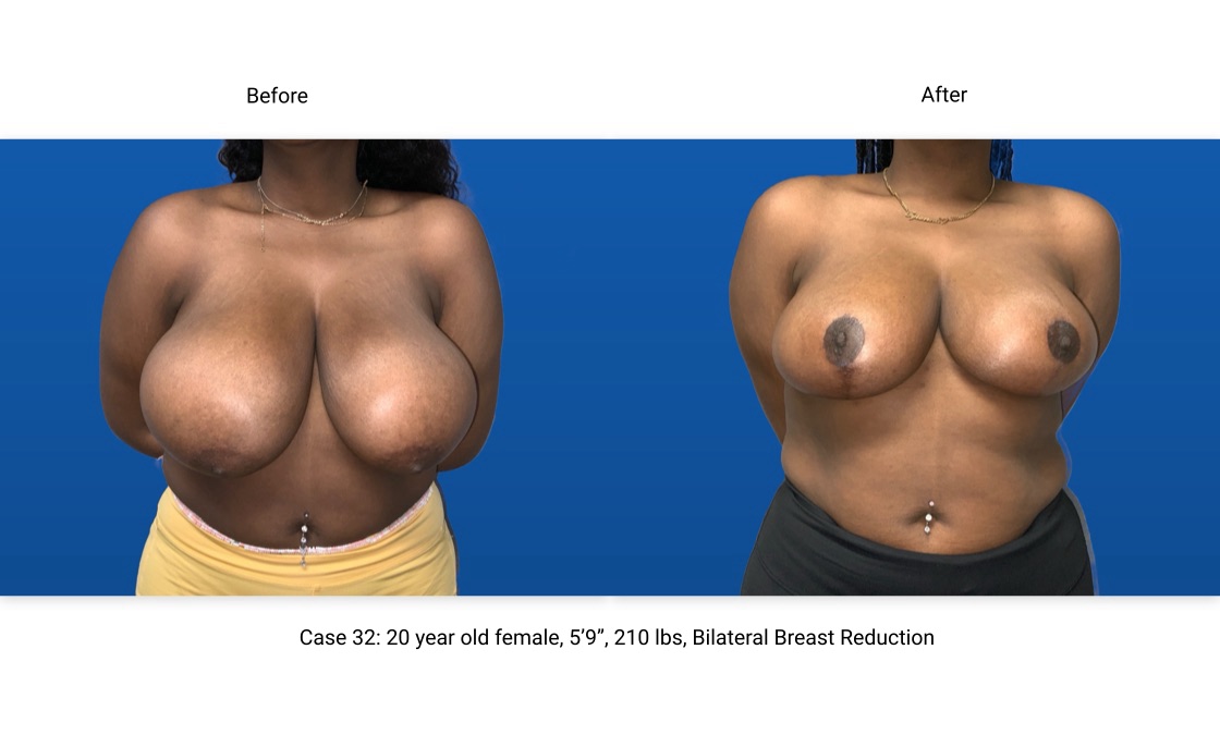 Case 32 Breast Reduction Front View