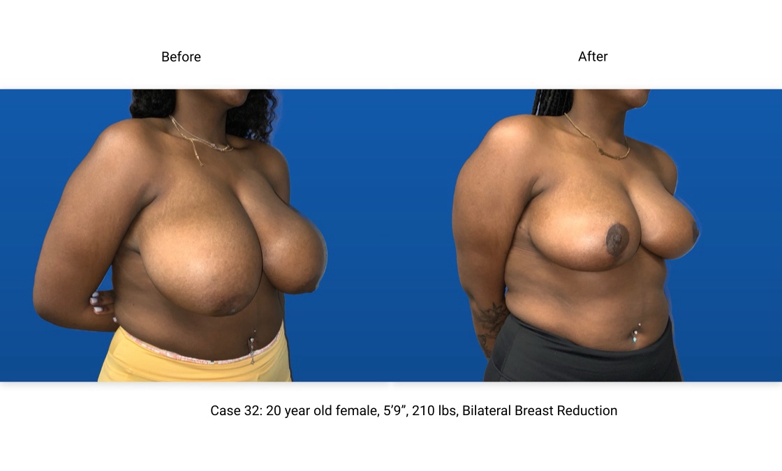 Case 32 Breast Reduction 3/4 View