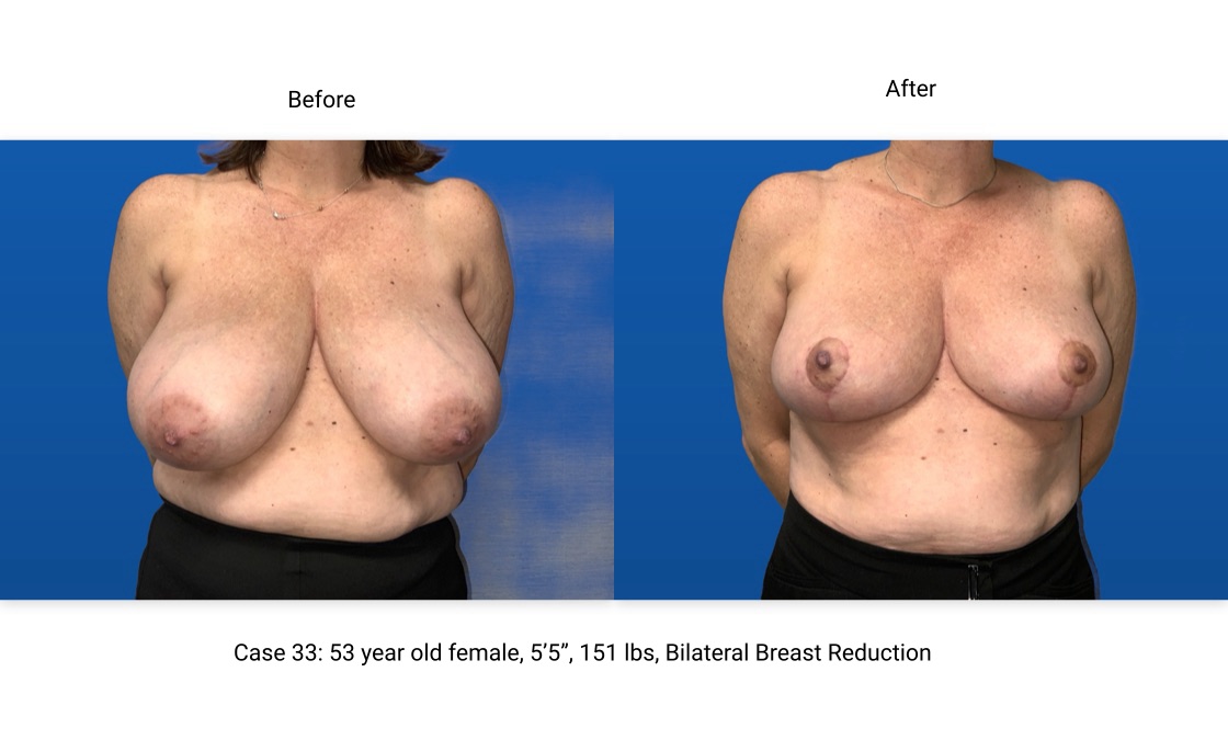 Case 33 Breast Reduction Front View