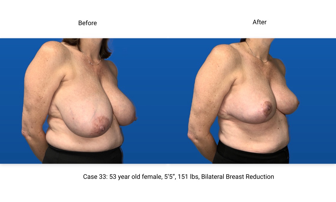 Case 33 Breast Reduction 3/4 View