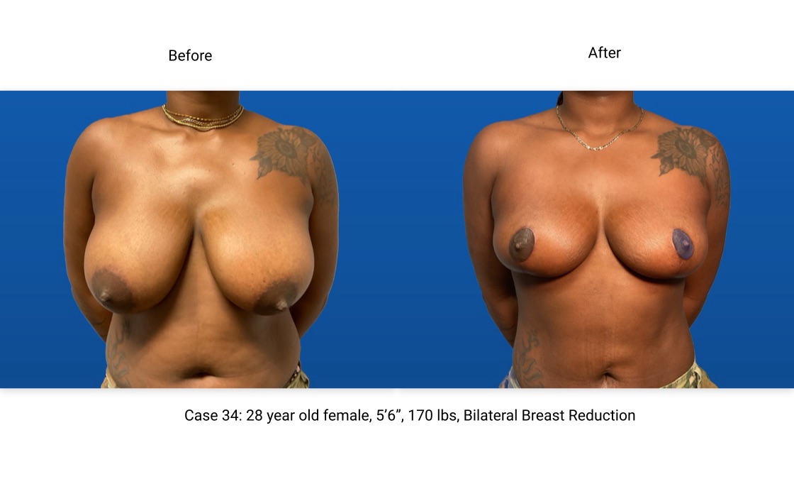 Case 34 Breast Reduction Front View