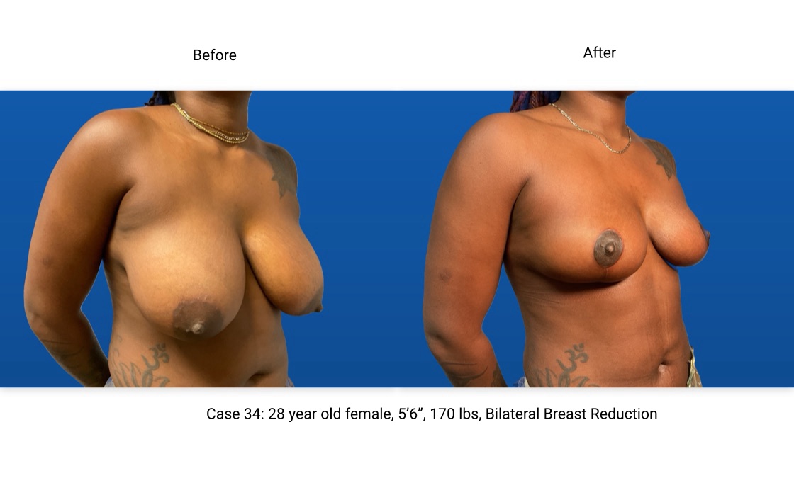 Case 34 Breast Reduction 3/4 View