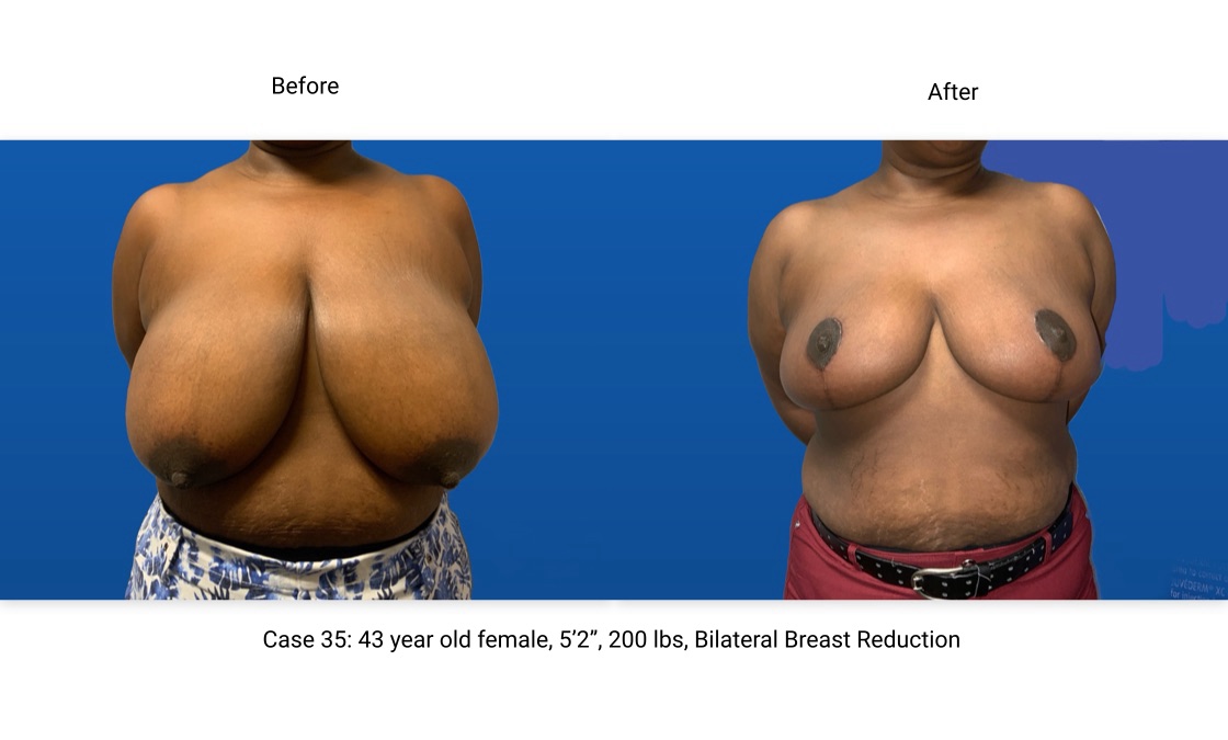 Case 35 Breast Reduction Front View