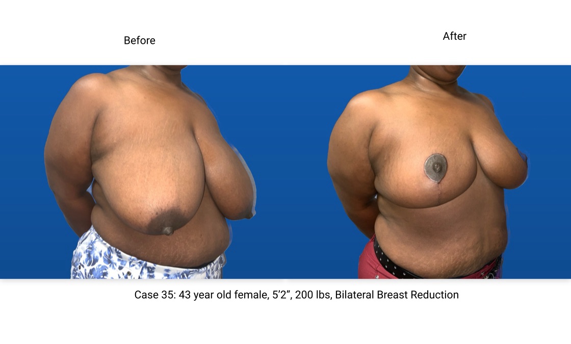 Case 35 Breast Reduction 3/4 View